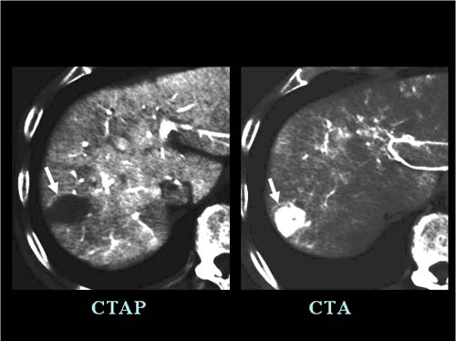 【進行型肝癌のCTA/CTAP画像】