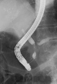 膵癌に対する胆道ステント留置術1