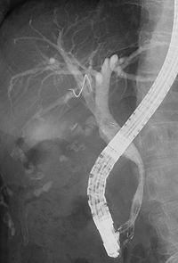 膵癌に対する胆道ステント留置術2