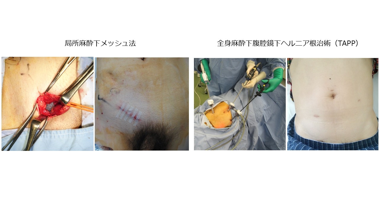 ヘルニア.jpg