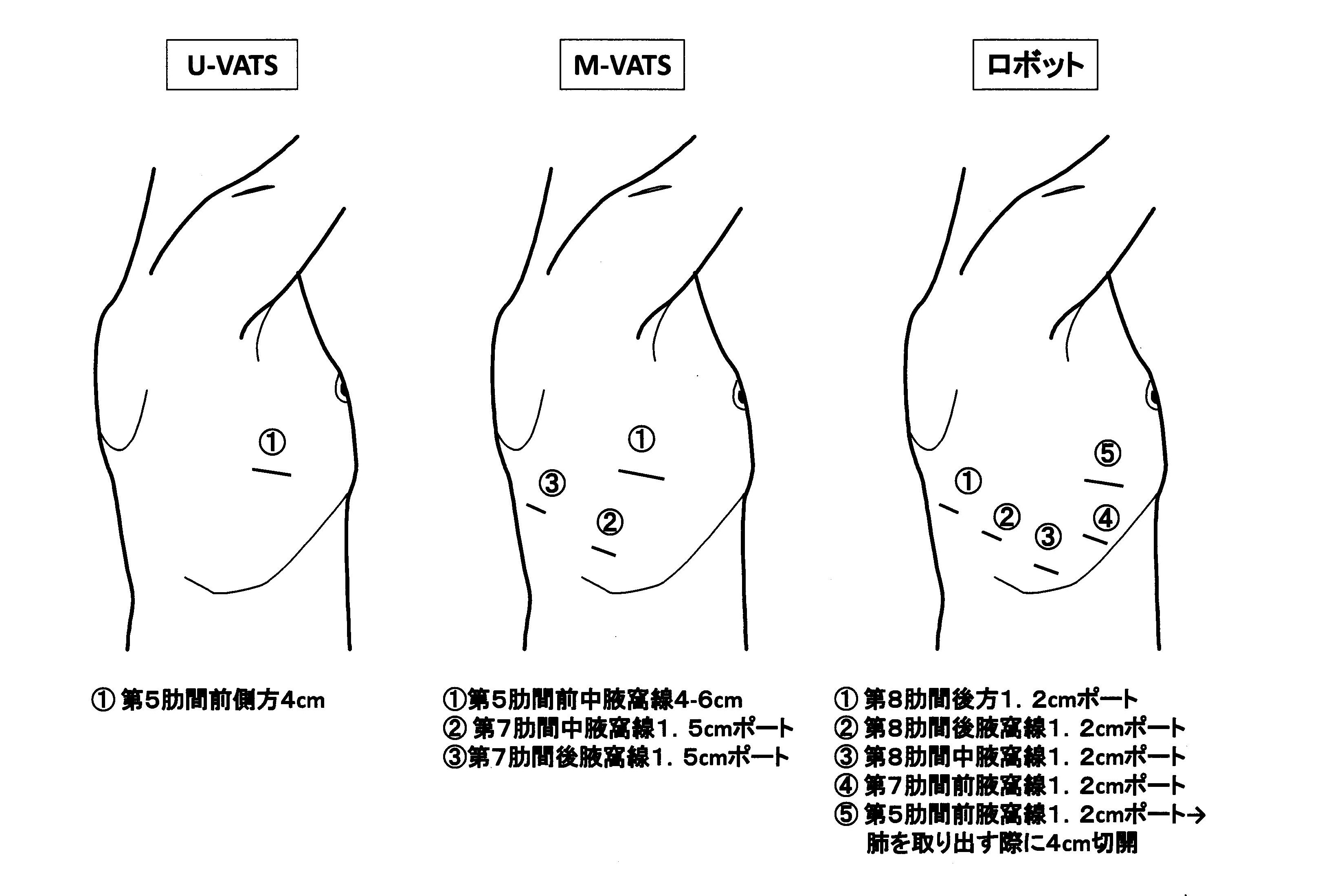 U-VATS%20M-VATS.jpg